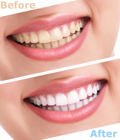 before and after teeth whitening at Contemporary Dental Arts